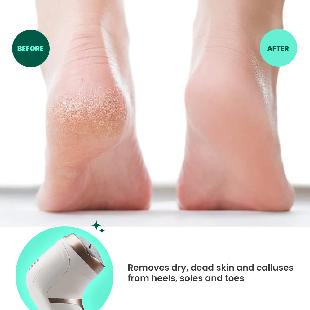 Igia Callus Free