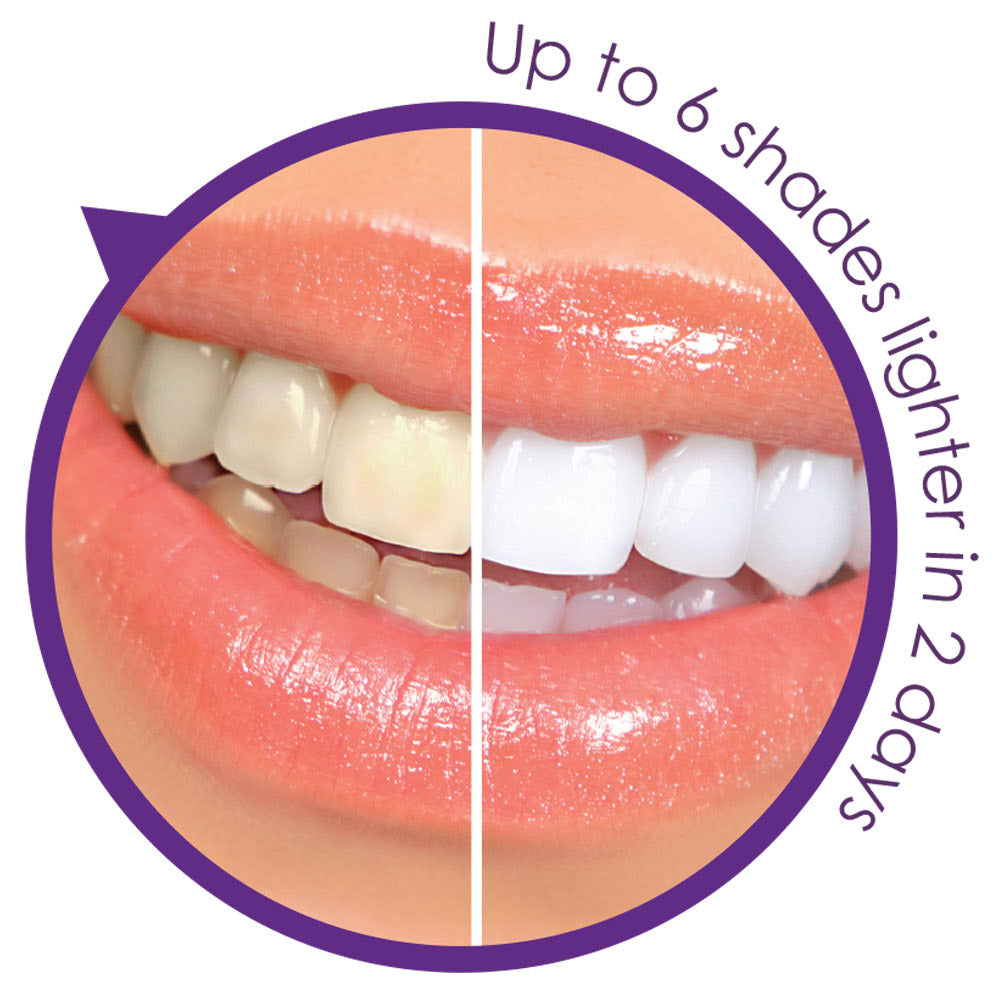 Remedy Health Professional Teeth Whitening Kit – Complete LED Teeth Whitening System