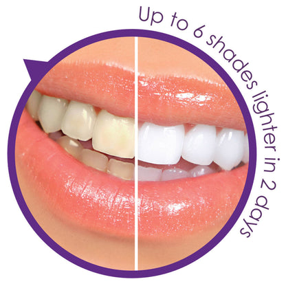 Remedy Health Professional Teeth Whitening Kit – Complete LED Teeth Whitening System